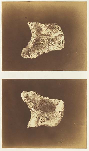 Microscopic Study (Esquilles dos Maxillaire Necrose)