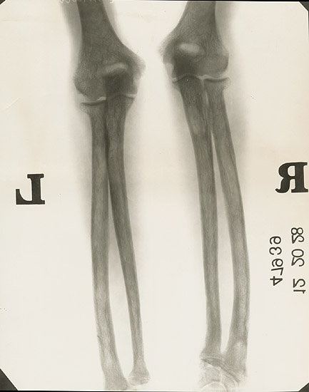 X-Ray of the Elbow (Humerus, Radius and Ulna)