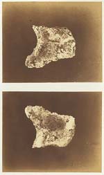Microscopic Study (Esquilles dos Maxillaire Necrose)