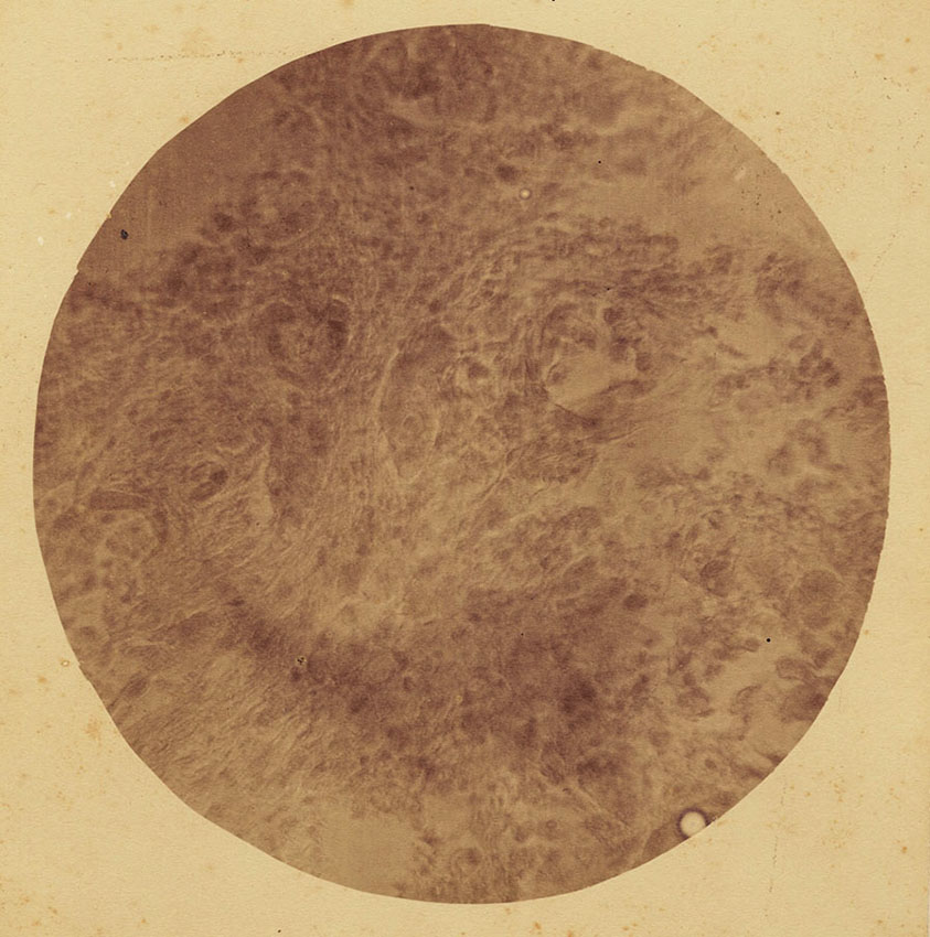 Dr. Samuel William Fletcher - Photo-Micrograph of Section of Cancer Dr. Samuel William Fletcher - Photo-Micrograph of Section of Cancer